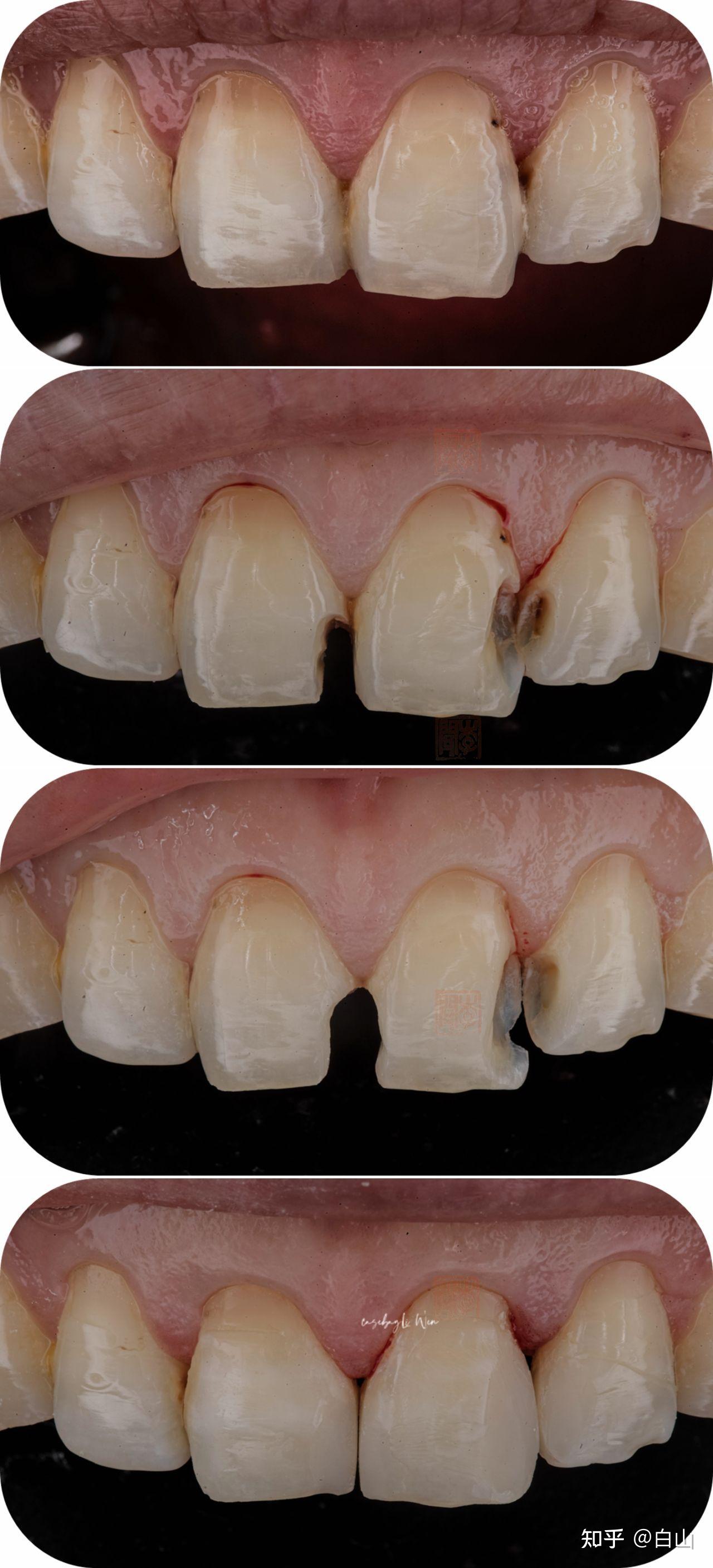 补完牙牙缝中间还有个洞正常么?