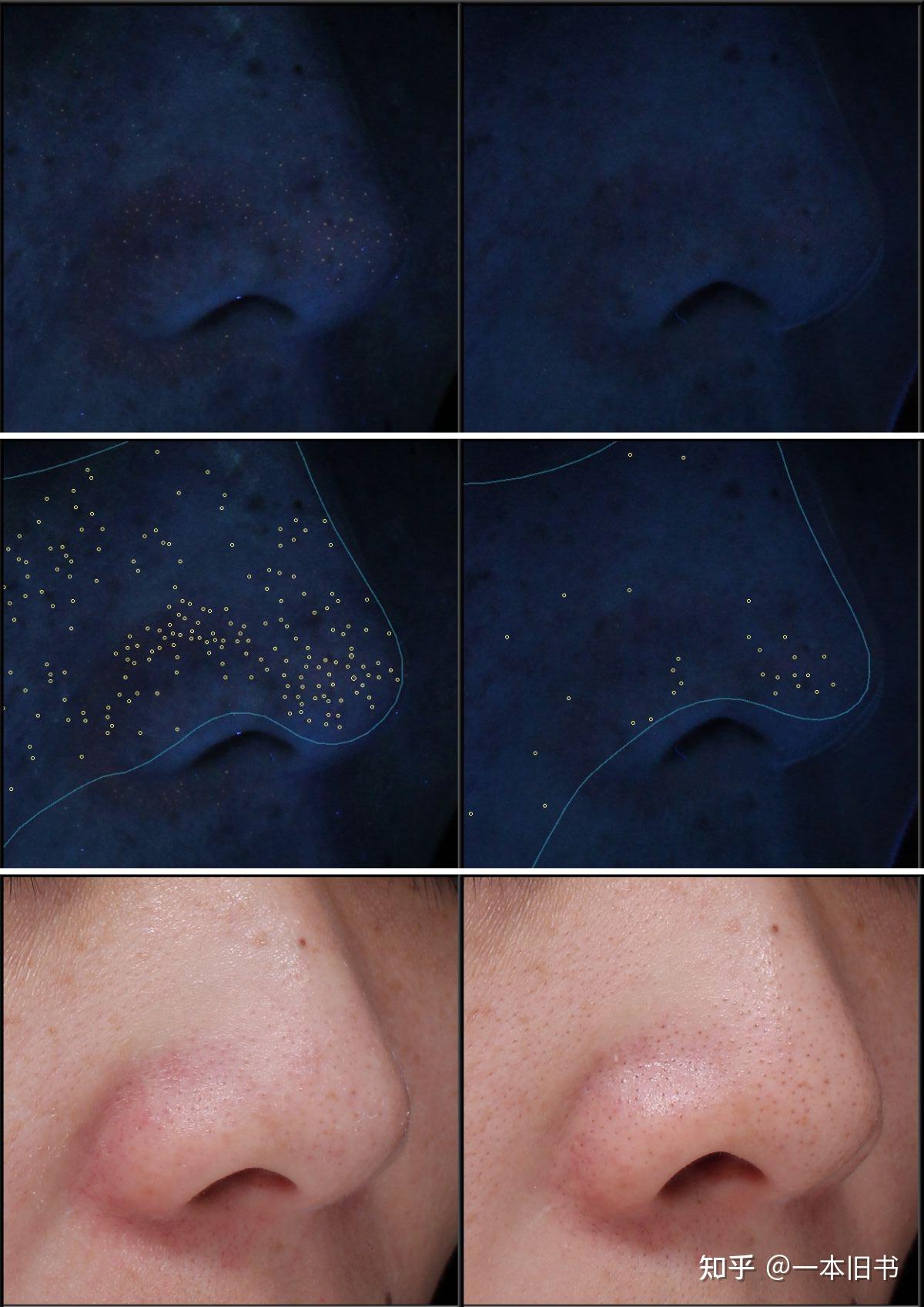 毛孔里有很多角栓怎么办?刷完酸第二天又出来了? - 知乎