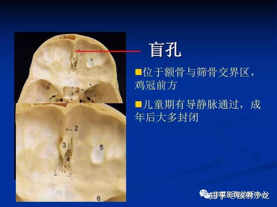 实用、详细的颅底各孔道影像解剖！ - 知乎