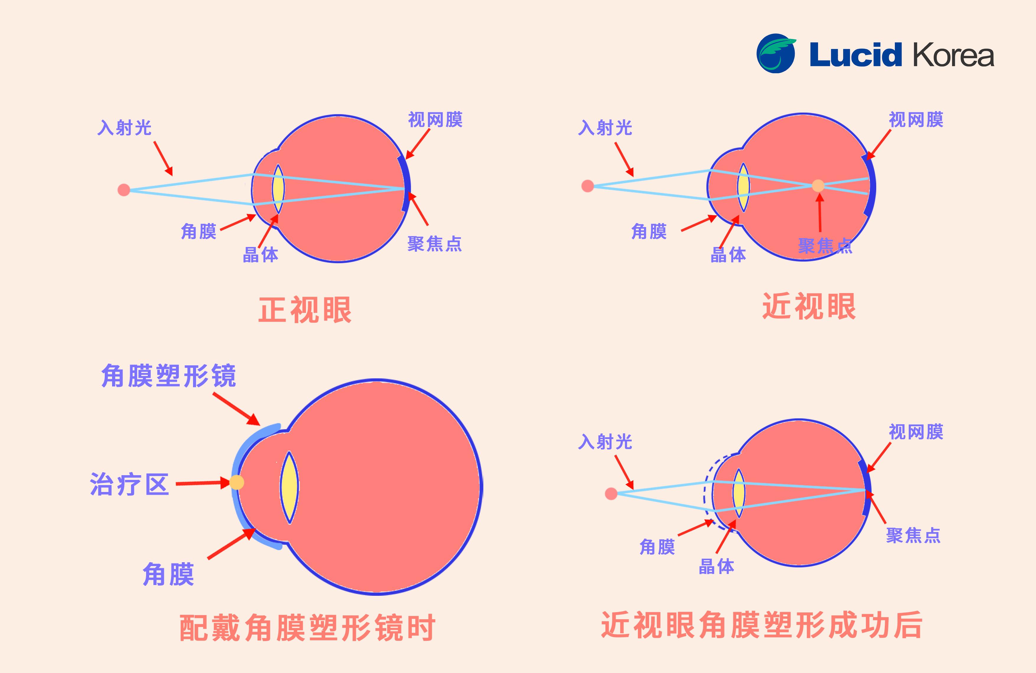 佩戴ok镜有什么危害应该注意什么