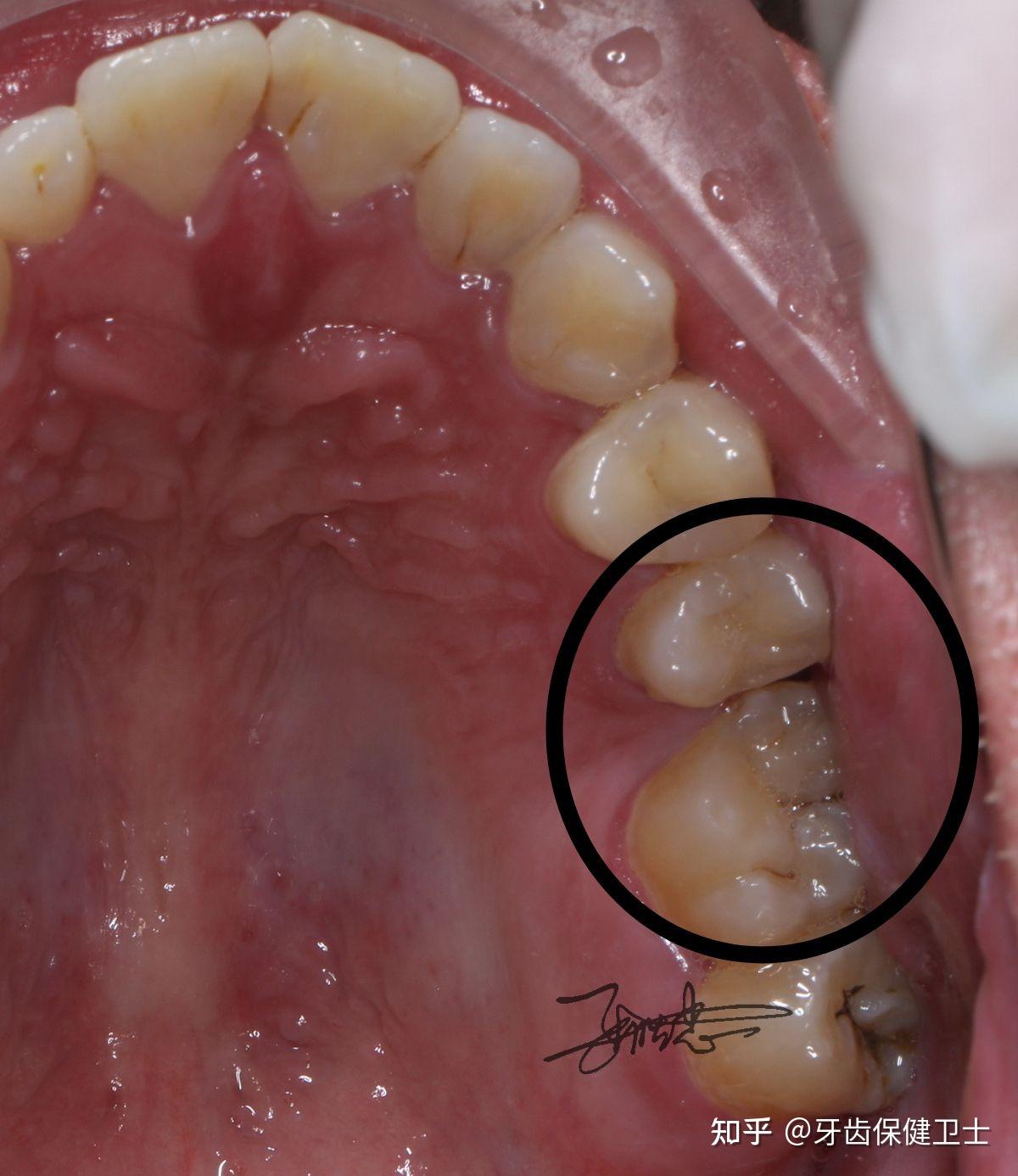 拔牙之后其他牙齿会移位吗