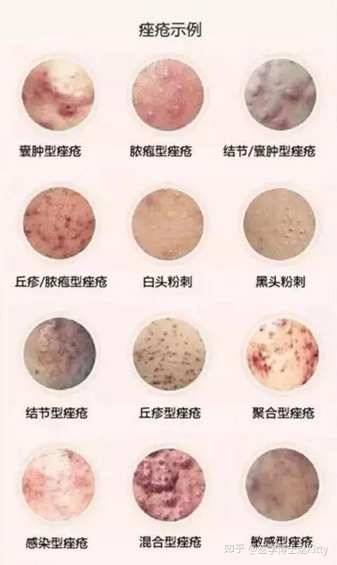 【痤疮科普篇】你的痤疮是怎么来的？以及如何修复/预防痤疮？ - 知乎