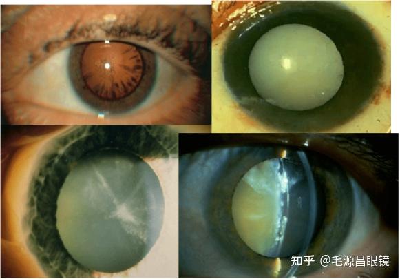 影响视觉的常见症状及视力矫正的常见眼病 - 知乎